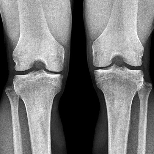 knee-arthroscopy