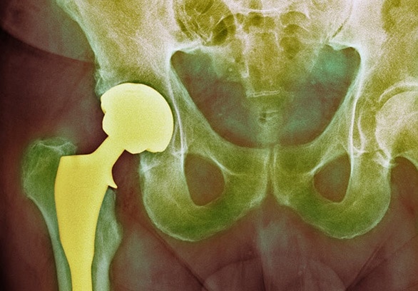 X ray of hips