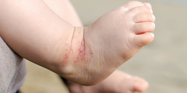 Eczema Understanding And Treating The Different Types Hcf Eczema Understanding And Treating The Different Types Hcf