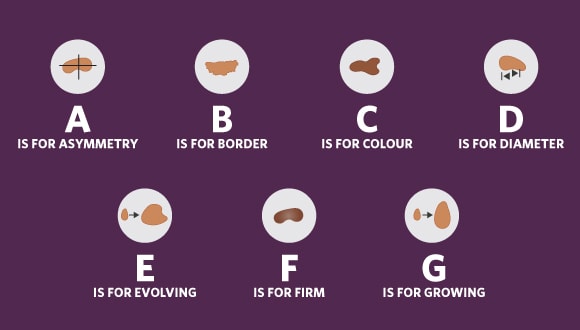 Criteria and markers for identifying skin cancer