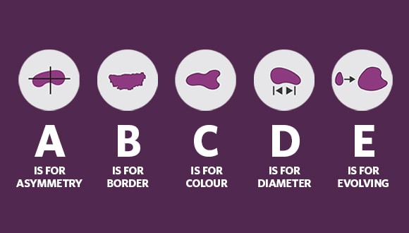 ABCDE checklist for moles