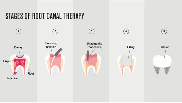 Stage of root canal