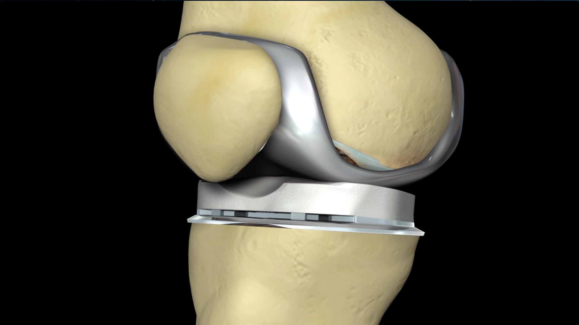 knee-replacement