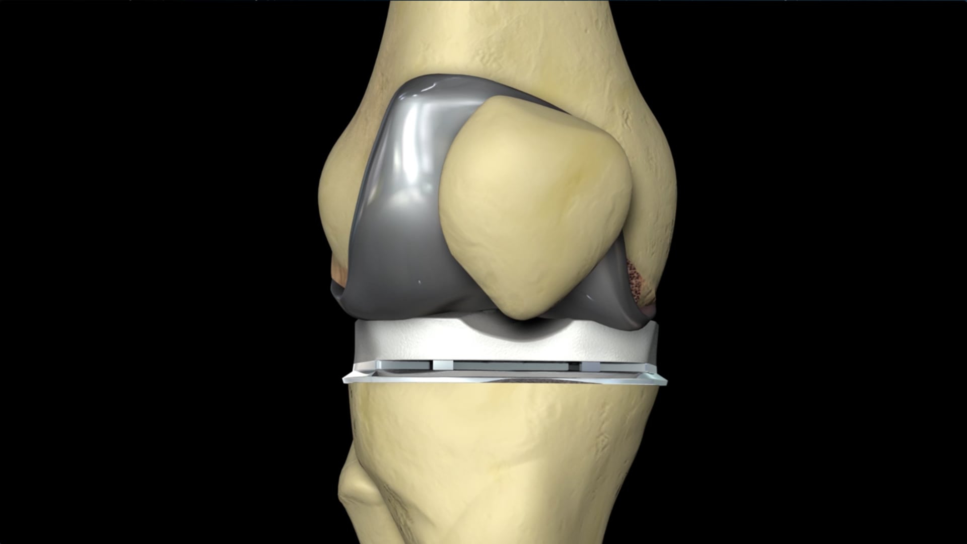 knee-replacement