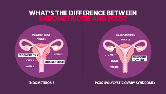 Illustration of woman's womb showing the difference of endometriosis vs PCOS